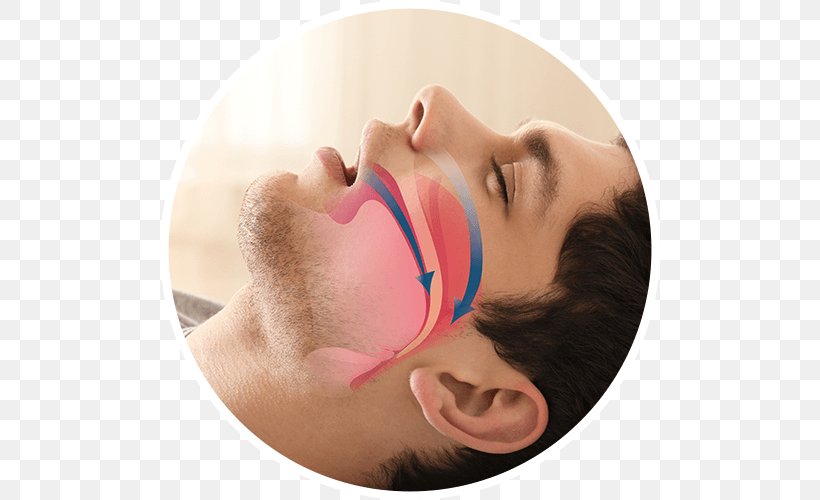 Obstructive Sleep Apnea Snoring Mandibular Advancement Splint Dentist, PNG, 500x500px, Sleep Apnea, Apnea, Beauty, Cheek, Chin Download Free