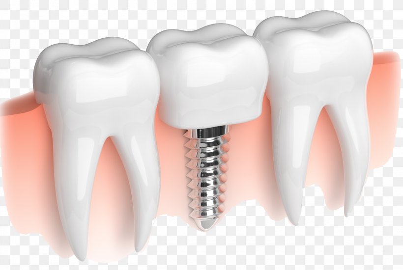 Dental Implant Dentistry Dentures Bridge, PNG, 1360x913px, Watercolor, Cartoon, Flower, Frame, Heart Download Free