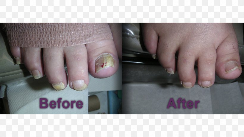 Nail Podiatry Foot Onychomycosis Medicine, PNG, 1110x625px, Nail, Disease, Finger, Foot, Hand Download Free