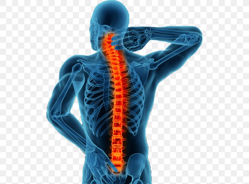 Vertebral Column Minimally Invasive Spine Surgery Spinal Fusion Back Pain, PNG, 516x605px, Vertebral Column, Back Pain, Electric Blue, Human, Human Back Download Free