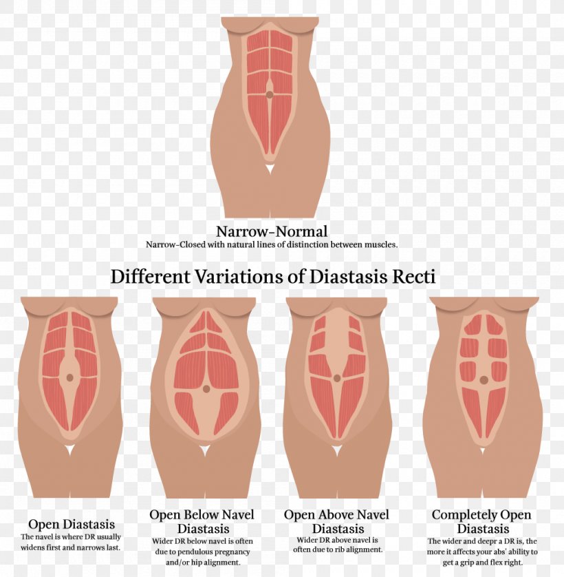 Diastasis Recti Rectus Abdominis Muscle Abdomen Physical Therapy, PNG, 1000x1022px, Watercolor, Cartoon, Flower, Frame, Heart Download Free
