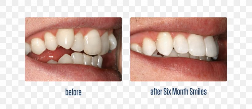 Human Tooth Dental Braces Cosmetic Dentistry, PNG, 1000x434px, Tooth, Cosmetic Dentistry, Dental Braces, Dental Degree, Dentistry Download Free