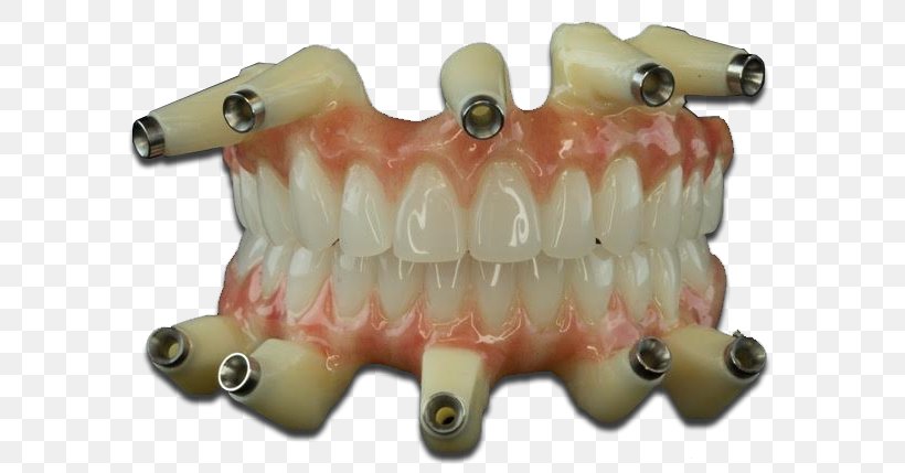 Dental Laboratory Dentures TC Dental Lab Dentistry Jaw, PNG, 640x429px, Dental Laboratory, Com, Dentistry, Dentures, Image Scanner Download Free