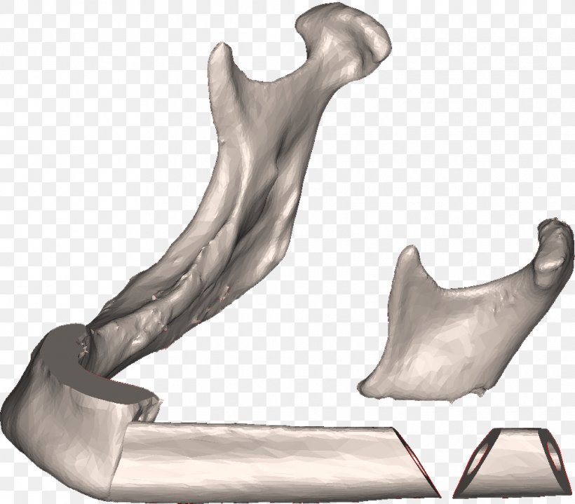 Fibula Surgery Mandible Osteotomy Bone, PNG, 1012x888px, Fibula, Arm, Autotransplantation, Bone, Bone Grafting Download Free