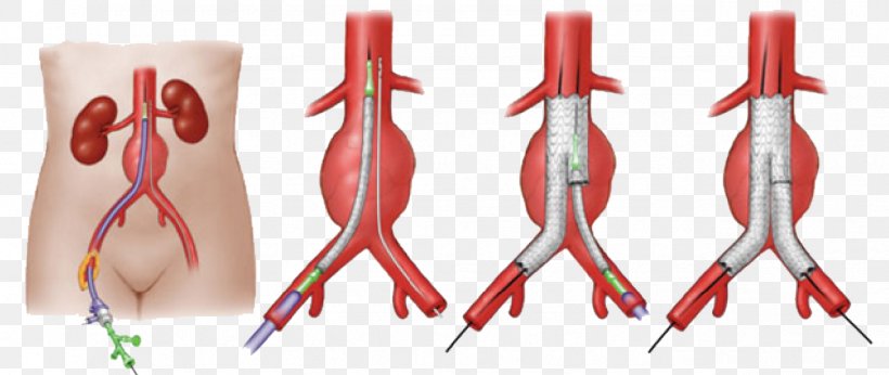 Abdominal Aortic Aneurysm Endovascular Aneurysm Repair Vascular Surgery, PNG, 1277x539px, Abdominal Aortic Aneurysm, Abdomen, Aneurysm, Aorta, Aortic Aneurysm Download Free