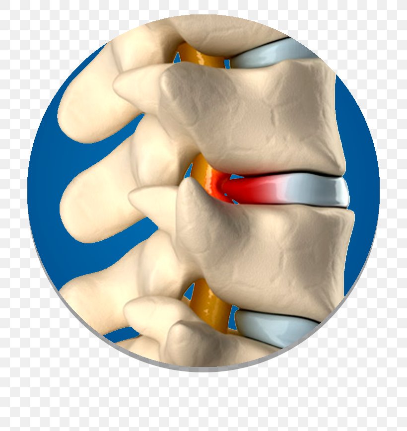 Spinal Disc Herniation Vertebral Column Surgery Intervertebral Disc, PNG, 750x868px, Spinal Disc Herniation, Ache, Arm, Back Pain, Cervical Vertebrae Download Free