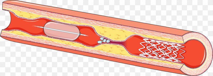 Pharmaceutical Drug Angioplasty Servier Medical Drug-eluting Stent, PNG, 1137x408px, Pharmaceutical Drug, Angioplasty, Art, Arteriosclerosis, Drug Download Free