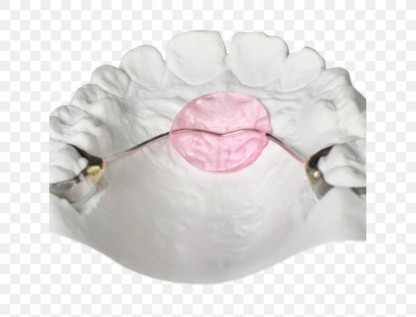 Orthodontics Bionator Jaw Orthodontic Technology Retainer, PNG, 625x625px, Orthodontics, Bed, Bionator, Cots, David Gergen Download Free