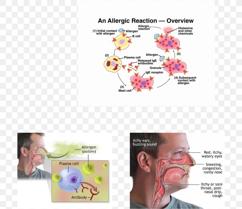 Type I Hypersensitivity Allergy Disease Health, PNG, 704x707px, Allergy, Antibody, Antigen, Bronchitis, Cheek Download Free