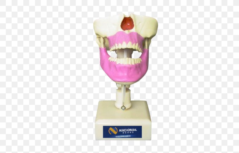 Maxilla Dentistry Alaleuanluu Jaw Surgery, PNG, 700x525px, Maxilla, Alaleuanluu, Anatomy, Dentistry, Gums Download Free