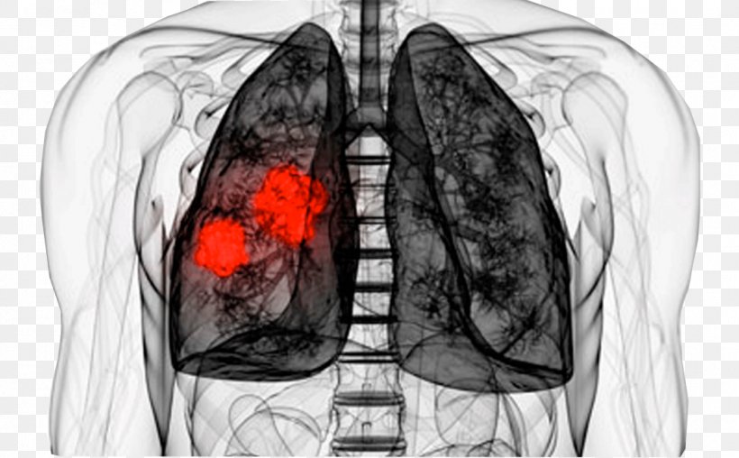 Lung Cancer Disease Therapy, PNG, 1056x655px, Watercolor, Cartoon, Flower, Frame, Heart Download Free