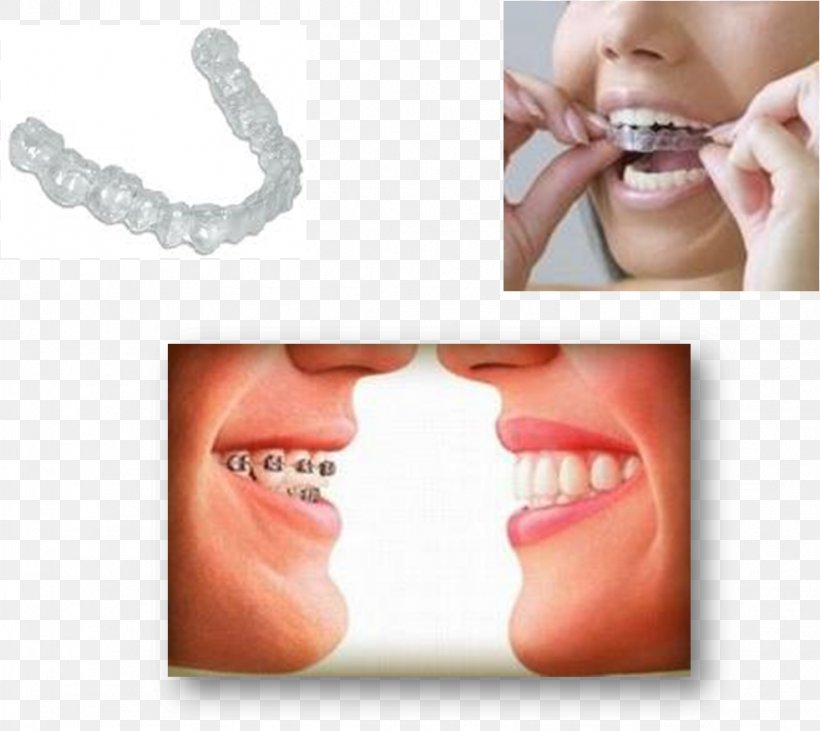 Tooth Dental Braces Orthodontics Crossbite Dentist, PNG, 982x876px, Tooth, Animal Bite, Cheek, Chin, Cosmetic Dentistry Download Free