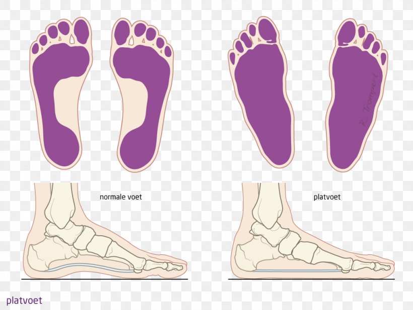 Foot Flat Feet Spreidvoet Patient Knee, PNG, 1020x768px, Watercolor, Cartoon, Flower, Frame, Heart Download Free