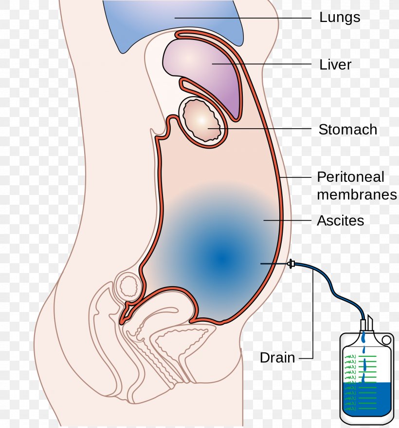 Ascites Paracentesis Abdomen Cirrhosis Peritoneum, PNG, 2000x2143px, Watercolor, Cartoon, Flower, Frame, Heart Download Free