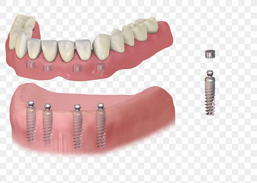 Dental Implant Dentistry Dentures Removable Partial Denture, PNG, 3500x2500px, Dental Implant, Bridge, Cosmetic Dentistry, Dental Extraction, Dental Restoration Download Free