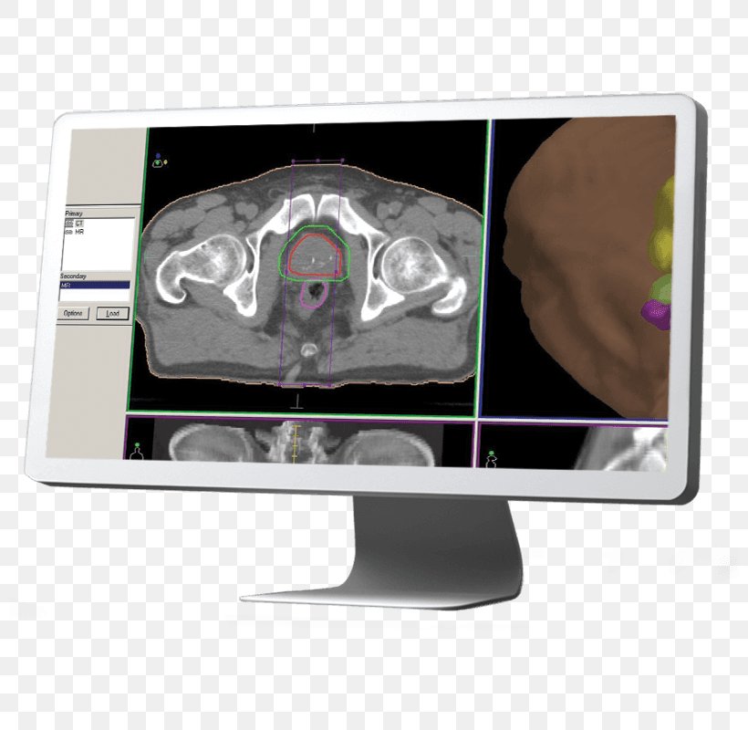 Elekta Xiotech Computer Monitors Radiation Therapy, PNG, 800x800px, Elekta, Computer Monitor, Computer Monitors, Display Device, Lars Leksell Download Free