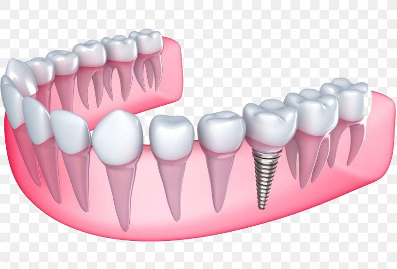 Desert View Dental Dental Implant Dentistry Dentures, PNG, 1114x755px, Dental Implant, Abutment, Brush, Cosmetic Dentistry, Dental Public Health Download Free