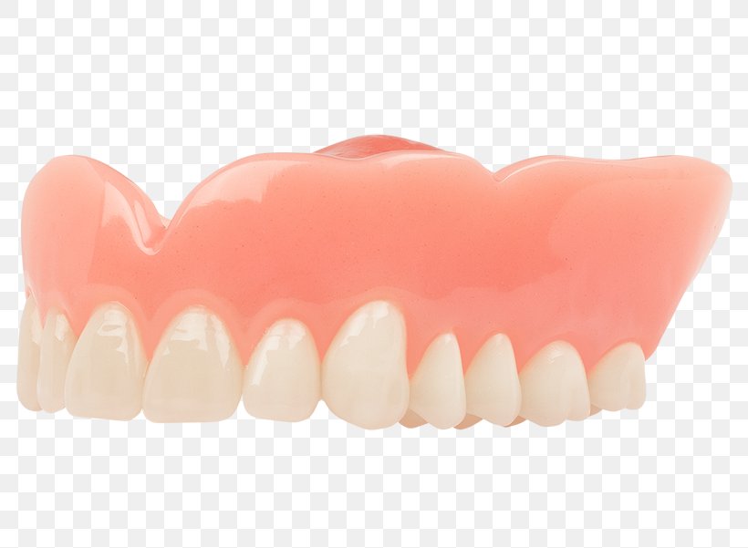 Dentures Tooth Dentistry Aspen Dental Dental Implant, PNG, 800x601px, Dentures, Aspen Dental, Cosmetic Dentistry, Crown, Dental Extraction Download Free