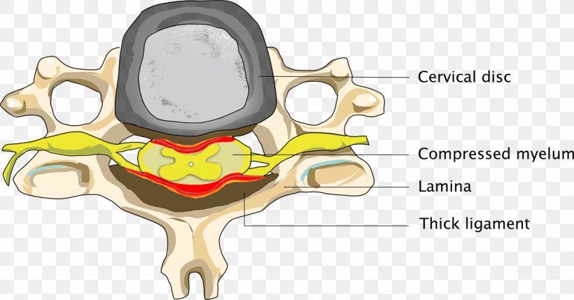 Cervical Spinal Stenosis Neck Spinal Cord, PNG, 1200x628px, Watercolor, Cartoon, Flower, Frame, Heart Download Free