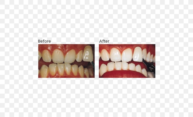 Tooth Whitening Dentistry Hydrogen Peroxide, PNG, 500x500px, Tooth, Cosmetic Dentistry, Dental Implant, Dentist, Dentistry Download Free