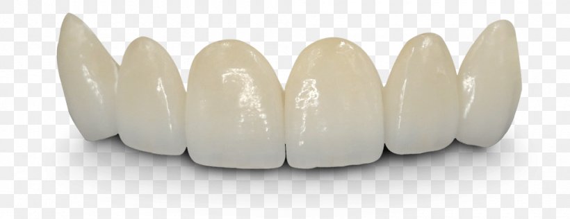 Bridge Crown Dentistry Dentures Tooth, PNG, 1000x386px, Bridge, Cosmetic Dentistry, Crown, Dental Implant, Dental Laboratory Download Free