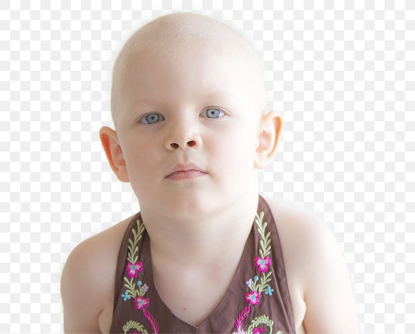 Burkitt's Lymphoma Cancer Therapy Child, PNG, 692x661px, Lymphoma, Cancer, Cheek, Chemotherapy, Child Download Free