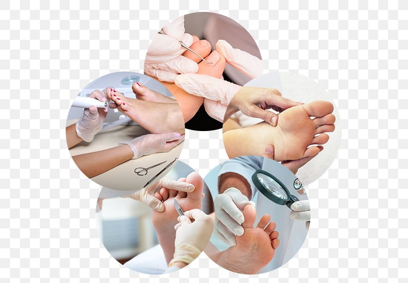 Plasencia Podiatry Podiatrist Foot Therapy, PNG, 570x570px, Plasencia, Callus, Clinic, Diabetes Mellitus, Diabetic Foot Download Free