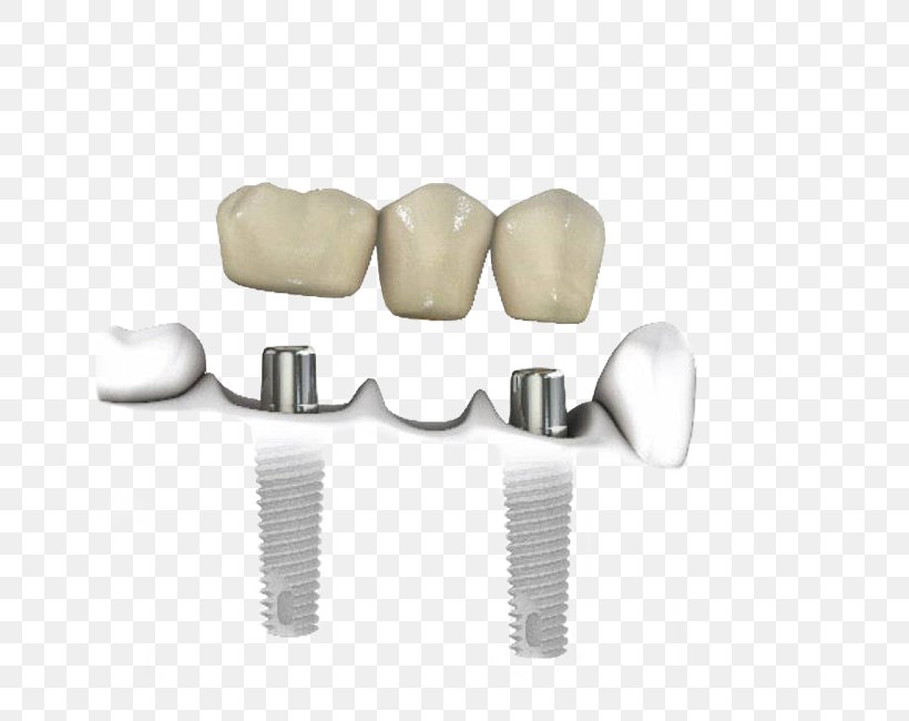 Tooth Dentistry Dental Implant, PNG, 650x650px, Tooth, Biocompatibility, Dental Implant, Dentist, Dentistry Download Free