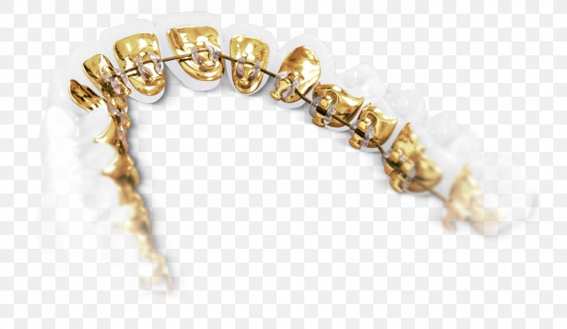 Dentistry Clear Aligners Dental Braces Orthodontics, PNG, 1378x801px, Dentistry, Body Jewelry, Bracelet, Clear Aligners, Clinic Download Free