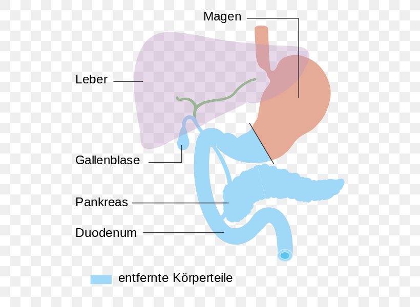 Pancreaticoduodenectomy Pancreatic Cancer Pancreas Thumb Surgery, PNG, 571x600px, Watercolor, Cartoon, Flower, Frame, Heart Download Free