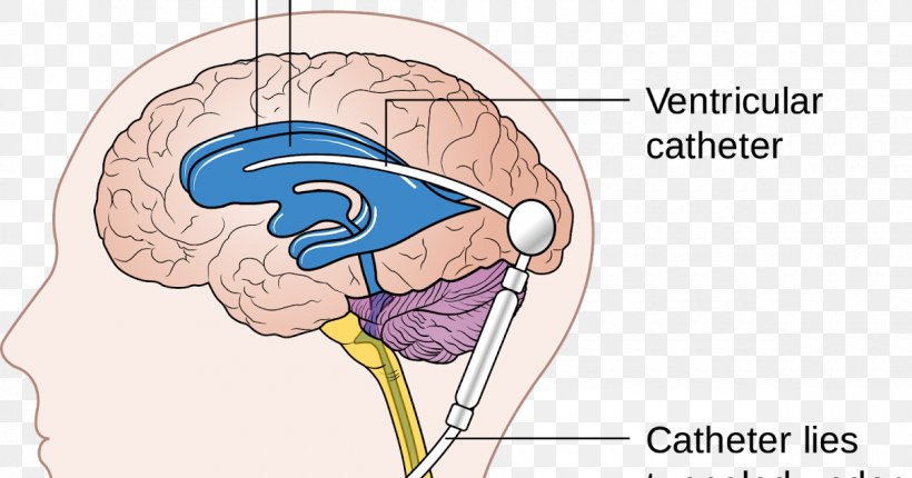 Cerebral Shunt Endoscopic Third Ventriculostomy Hydrocephalus Cerebrospinal Fluid, PNG, 1200x630px, Watercolor, Cartoon, Flower, Frame, Heart Download Free