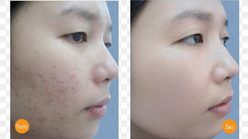 Mụn Acne Scar Therapy Hemorrhoid, PNG, 900x506px, Mun, Acne, Cheek, Chin, Close Up Download Free