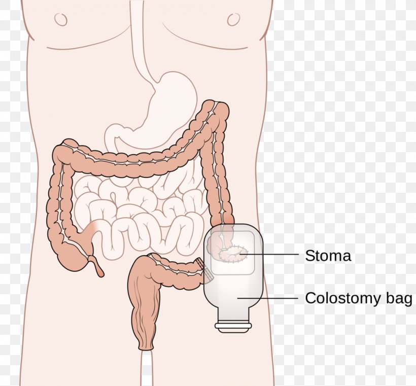 Colostomy Colectomy Surgery Ileostomy Stoma, PNG, 1000x929px, Watercolor, Cartoon, Flower, Frame, Heart Download Free