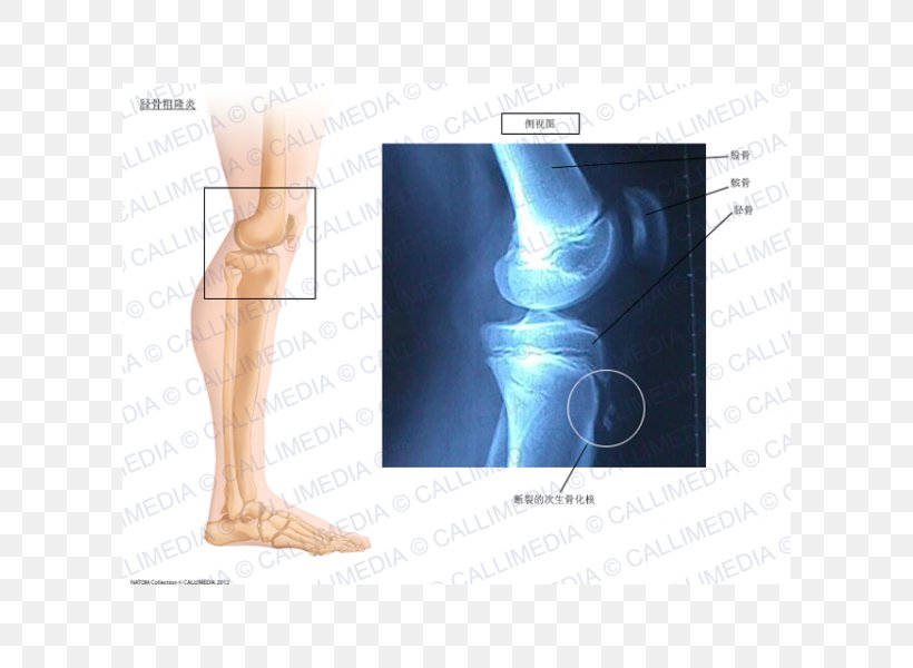 Knee Osgood–Schlatter Disease Ossification Tibia, PNG, 600x600px, Watercolor, Cartoon, Flower, Frame, Heart Download Free