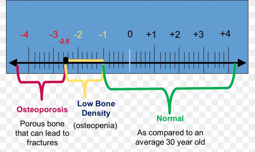 Bone Density Dual-energy X-ray Absorptiometry Osteopenia Densitometry, PNG, 1343x804px, Bone Density, Area, Bone, Bone Fracture, Bone Health Download Free