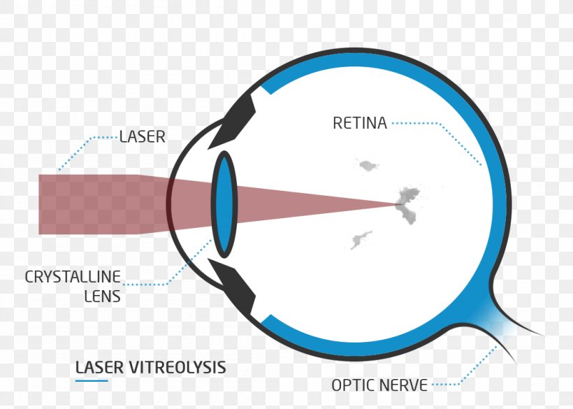 Presbyopia Far-sightedness Floater Eye Visual Perception, PNG, 1050x750px, Presbyopia, Astigmatism, Blue, Blurred Vision, Brand Download Free