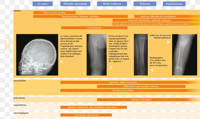 Alkaline Phosphatase Hypophosphatasia Craniosynostosis, PNG, 1284x766px, Alkaline Phosphatase, Alkali, Brand, Craniosynostosis, Disease Download Free