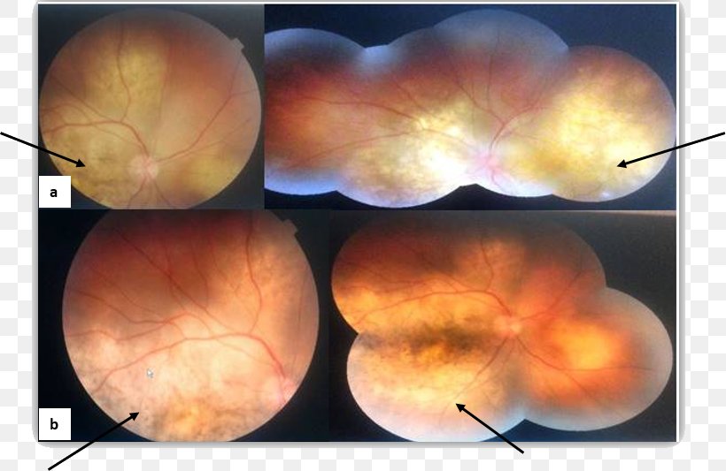 Eye Choroid Metastasis Fundus Extended-spectrum Penicillin, PNG, 820x533px, Eye, Betalactamase, Bone, Brain, Choroid Download Free