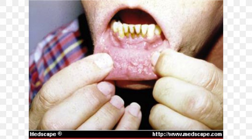 Gums Dipping Tobacco Lip Copenhagen Dentistry, PNG, 866x477px, Gums, Chewing Tobacco, Chin, Close Up, Copenhagen Download Free