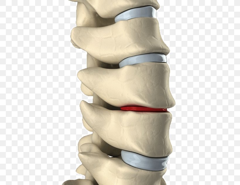 Lumbar Disc Herniation Intervertebral Disc Spinal Decompression Back Pain Vertebral Column, PNG, 580x633px, Intervertebral Disc, Arm, Back Pain, Finger, Hand Download Free