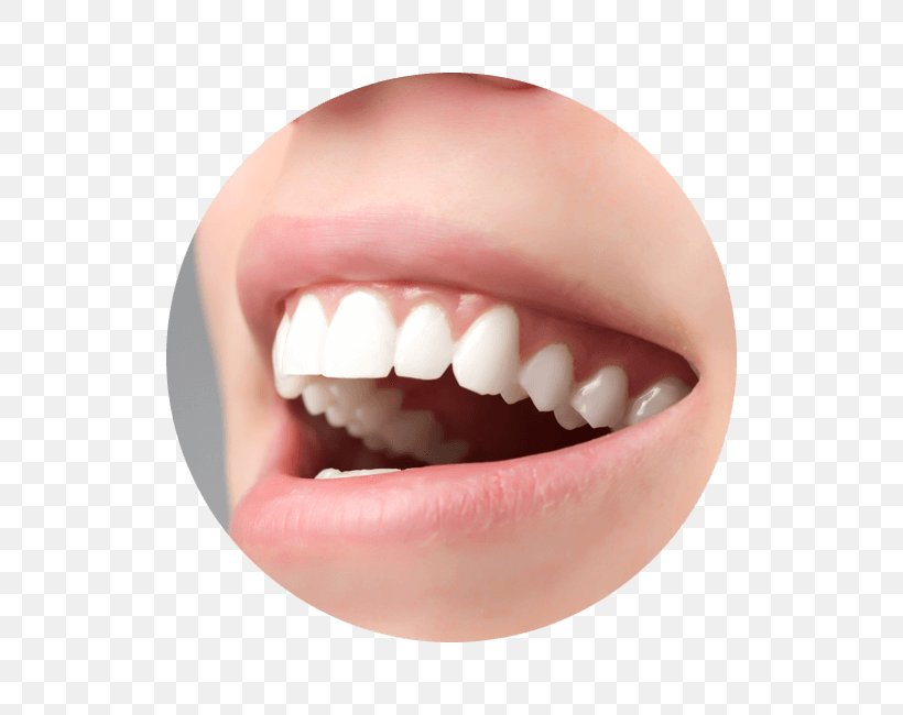 Crown Ceramic Tooth Veneer Dentistry, PNG, 650x650px, Crown, Aesthetics, Ceramic, Cermet, Chin Download Free
