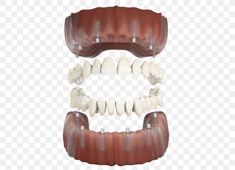 Human Tooth, PNG, 500x596px, Human Tooth, Jaw, Mouth, Tooth Download Free