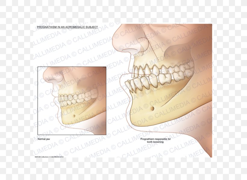 Acromegaly Prognathism Jaw Endocrinology Symptom, PNG, 600x600px, Watercolor, Cartoon, Flower, Frame, Heart Download Free