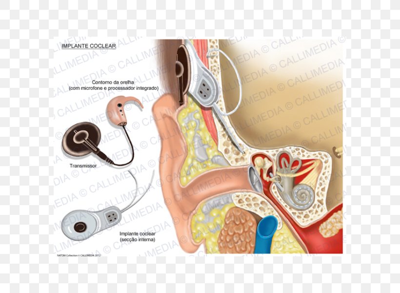 Cochlear Implant Hearing, PNG, 600x600px, Watercolor, Cartoon, Flower, Frame, Heart Download Free