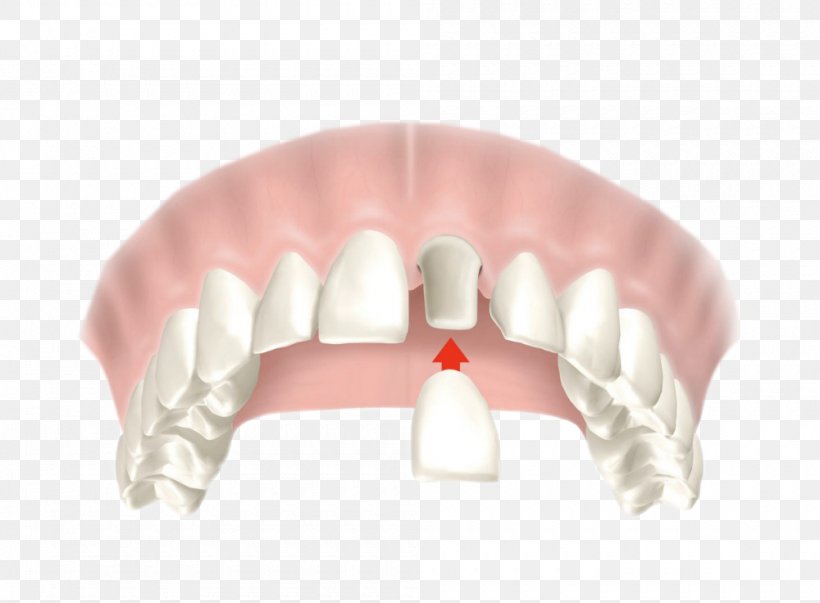 Crown Dentistry Bridge Dental Restoration, PNG, 1000x736px, Crown, Bridge, Cosmetic Dentistry, Dental Implant, Dental Impression Download Free
