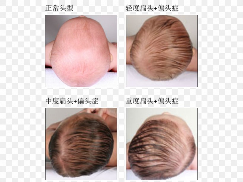 Head Cephalic Index Child Infant Plagiocephaly, PNG, 990x742px, Head, Birth, Brain, Child, Deformity Download Free