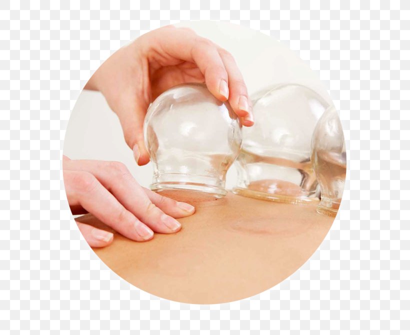 Cupping Therapy Bekam Medicine Massage, PNG, 628x670px, Cupping Therapy, Acupuncture, Alternative Health Services, Blood, Chiropractic Download Free