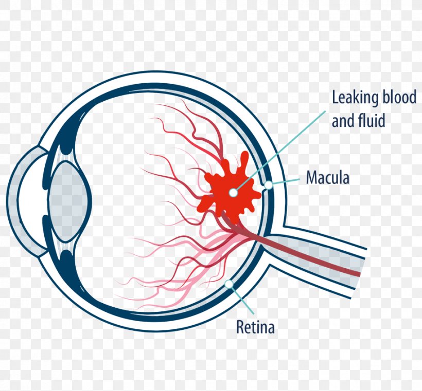 Macula Of Retina Macular Edema Diabetic Retinopathy Eye, PNG, 915x850px, Watercolor, Cartoon, Flower, Frame, Heart Download Free