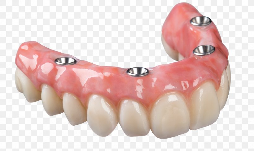 Dental Implant Dentures All-on-4 Removable Partial Denture Bridge, PNG, 1680x1000px, Dental Implant, Bridge, Cosmetic Dentistry, Crown, Dental Laboratory Download Free