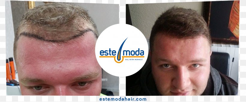 Este Moda Hair Saç Ekim Merkezi Forehead Hair Transplantation Hair Coloring Capelli, PNG, 1920x800px, Forehead, Adana, Beard, Buzz Cut, Capelli Download Free